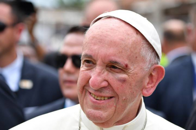 Папа Римский Франциск упал и разбил левую скулу и бровь во время поездки на папамобиле в Колумбии. 