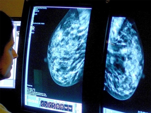 Команде ученых из Национального университета рака в США удалось вылечить пациентку с раком груди на последней стадии. 